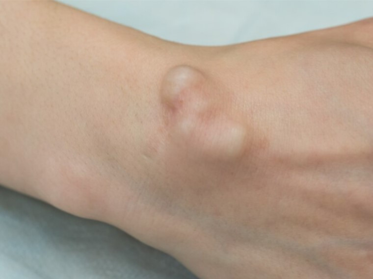 Kista Ganglion